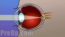 Laser Eye Surgery PRK - PreOp Patient Education HD