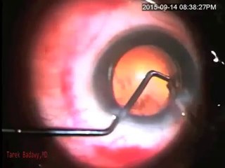 Bausch & Lomb & Cataract