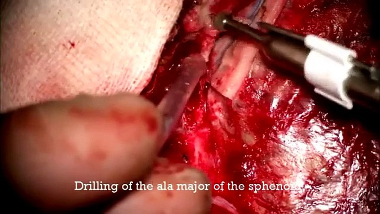 Clipping & Internal carotid artery