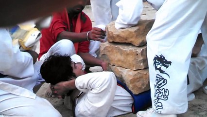 Multiple stone breaking on abdomen