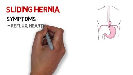 Hiatus Hernia