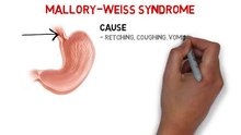 Mallory Weiss Syndrome