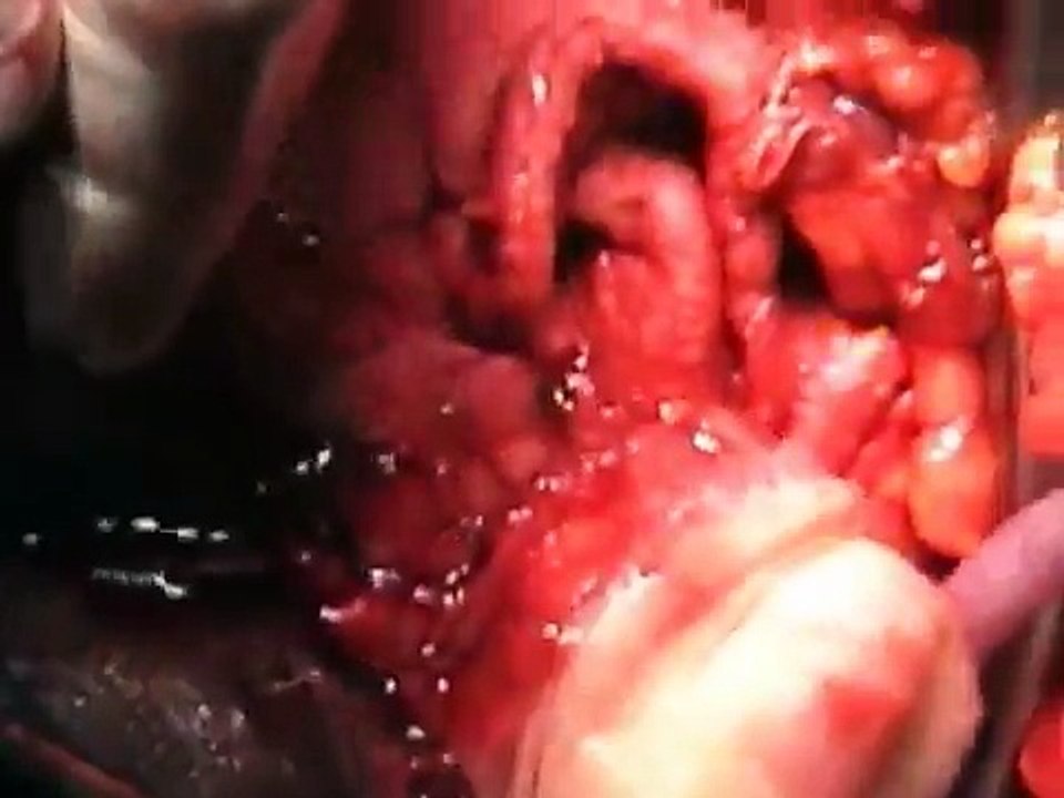 Total Abdominal Hysterectomy procedure