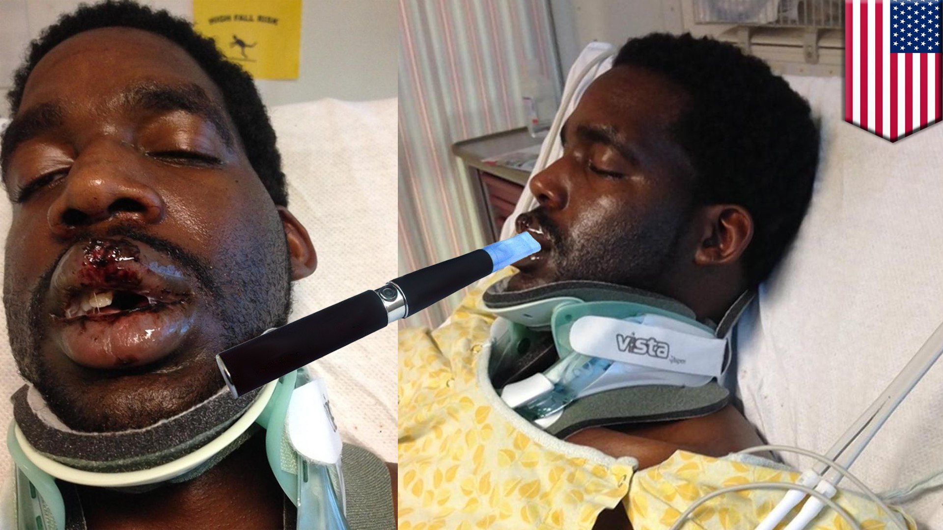 elfbar elfa master akku E-cigarette breaks man's neck and teeth in vape explosion