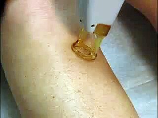 Laser Hair Removal Treatment