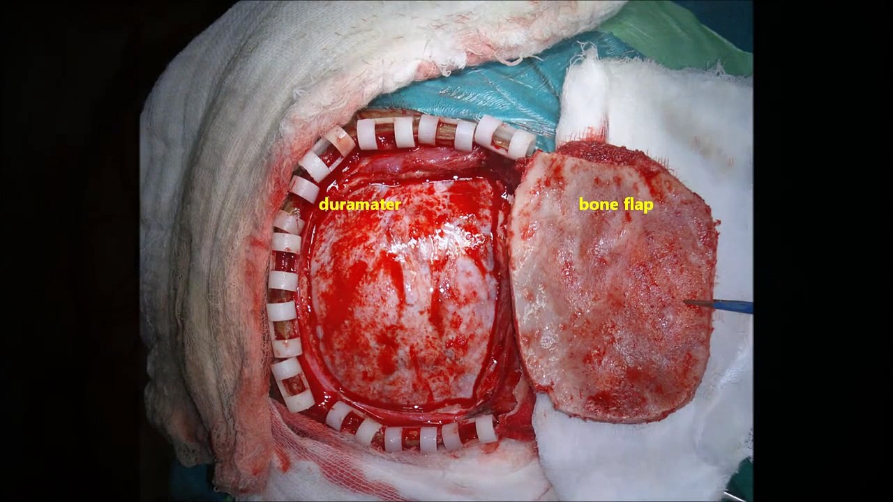 brain tumor- olfactory groove meningioma-microsurgery-dr suresh dugani/HUBLI/INDIA