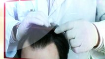 CapiCell - Tratamiento para la alopecia en Hombres y mujeres