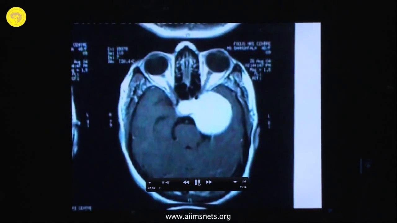 Anterior Clinoid Drilling - Operative Procedure - 1