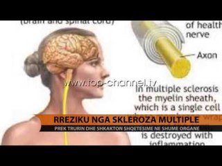 Rreziku nga skleroza multiple - Top Channel Albania - News - Lajme