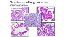 Fighting Lung Cancer, Part 3 | Advances in Early Lung Cancer Detection