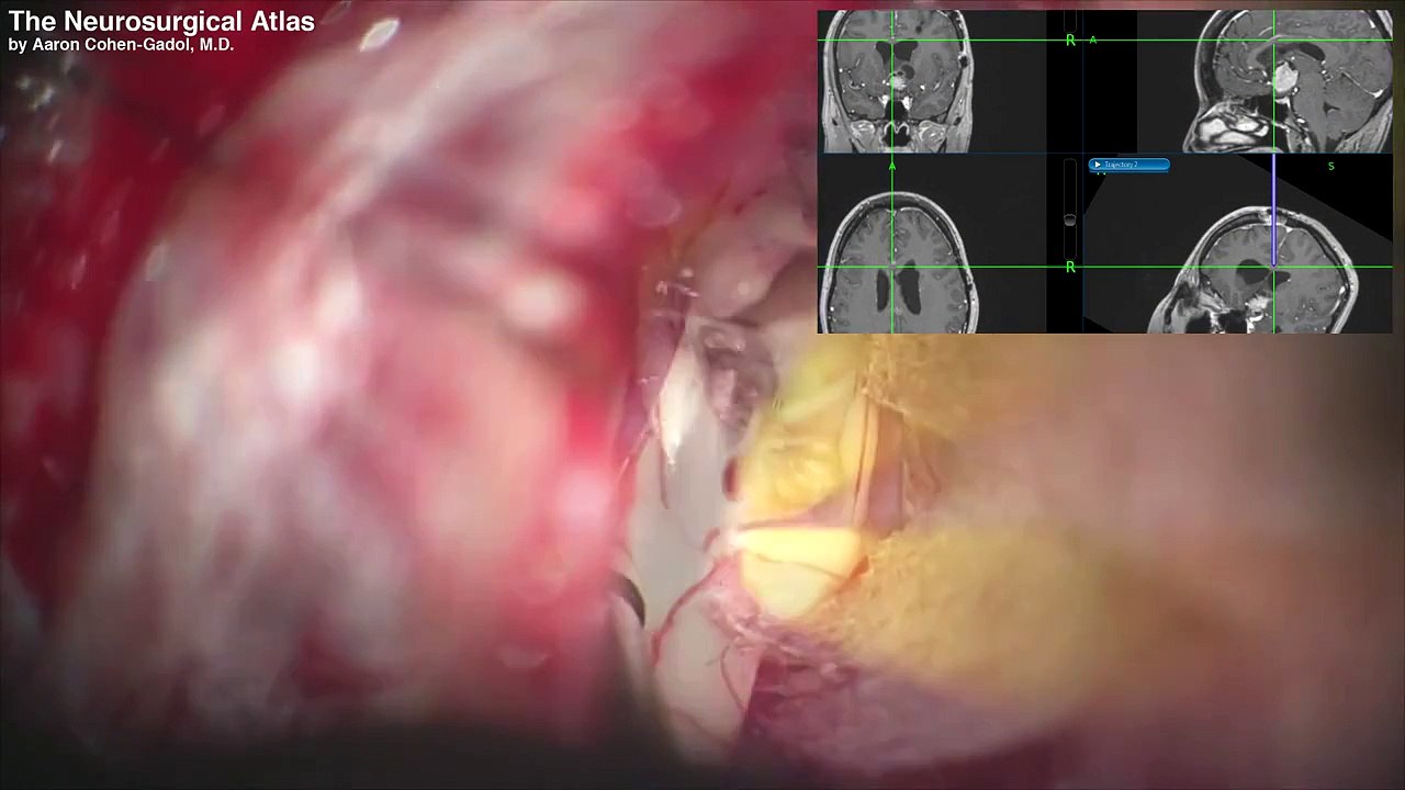 Resection of large epidermoid tumors ventral to the brainstem