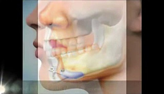 Chin Augmentation Surgery in Mumbai, India - The Esthetic Clinics