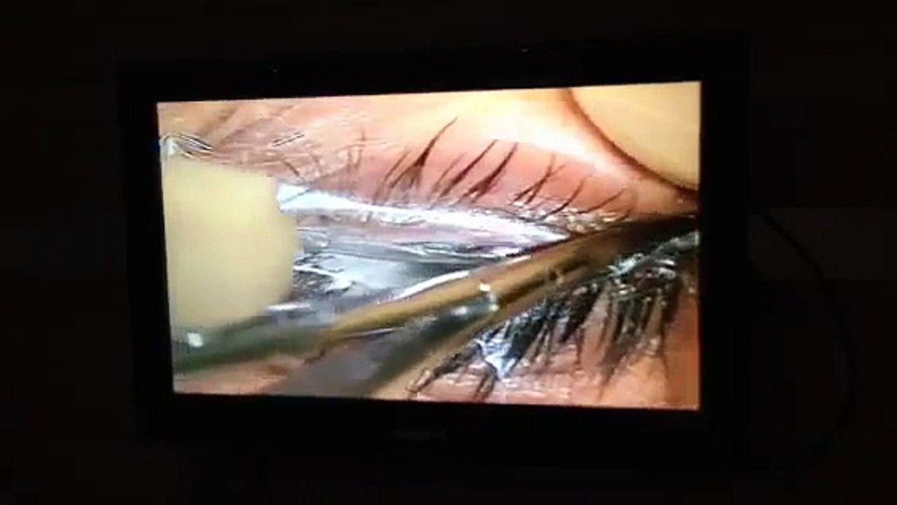 My LASEK Eye Surgery