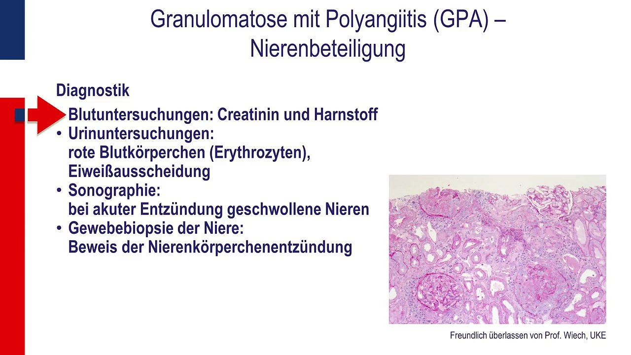 Eosinophile Granulomatose mit Polyangiitis - Teil 1
