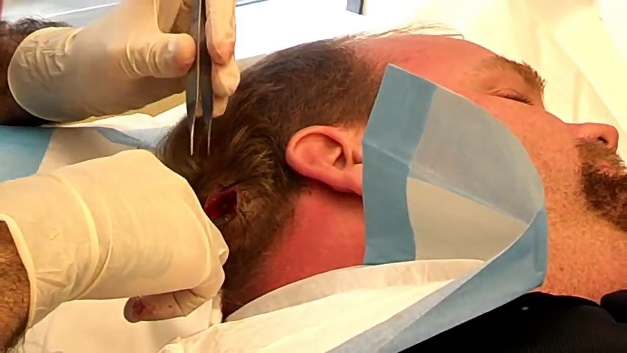Surgical breast stitching after cyst removal!