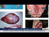 16 حالة واصابة بوباء الحمى المالطية  بولاية البويرة