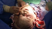 Inside the Complex Face Transplant Surgery: Part 2