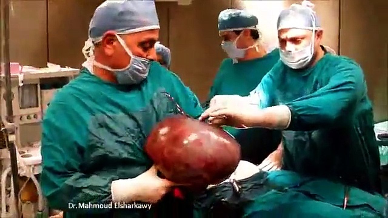 Total abdominal hysterectomy with bilateral salpingo-oophorectomy (part 1)