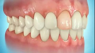 Имплант - восстановление утраченного зуба