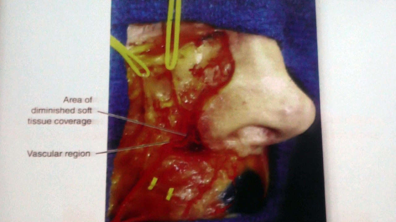 Dr Haroon nabi & Dr Mozzam N tarer Fillers work shop Part 9