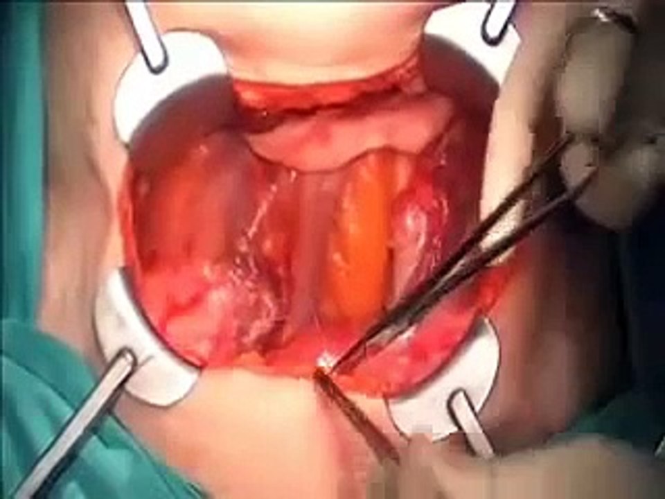 Nerve sparing radical hysterectomy for cervical cancer - part 1 of 2 (no edition)