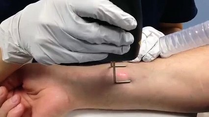 Scar Revision with Fractional Laser