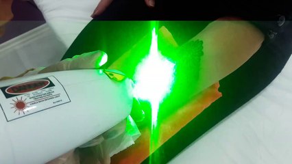 Dövme Silme Gaziantep Now Güzellik Salonu Fiyat İçin İrtibat 0342 320 0099