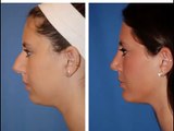 Rhinoplasty Portland Oregon. Best Rhinoplasty Expert in Portland OR