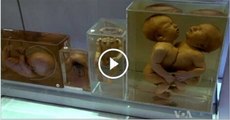 Medical Museum - anatomical collections of bones - preserved human organs
