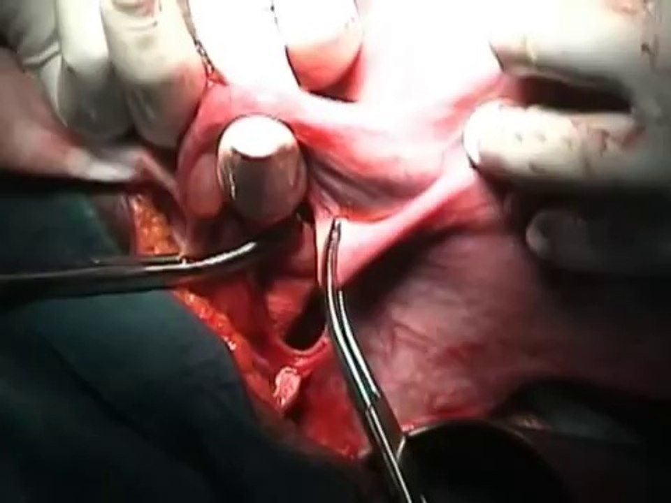 Total Abdominal Hysterectomy | Atlas of Gynecologic Surgery