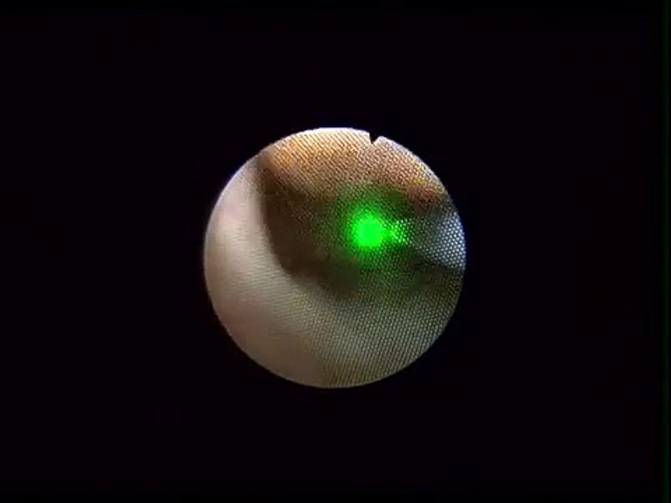 HealthEast Kidney Stone Institute - Live Ureteroscopy Procedure w/Active Fragment Extracti