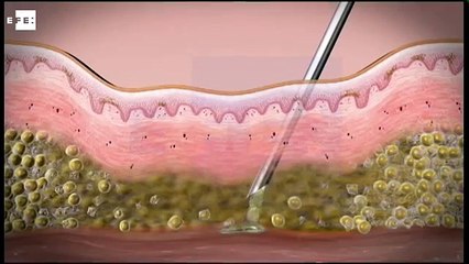 Nueva terapia corregirá los defectos estéticos del tratamiento contra el VIH