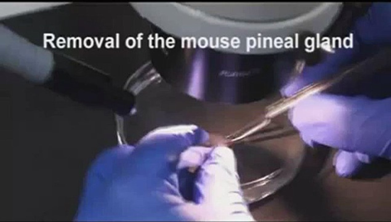 Pineal Gland Tumor Surgery Explained Medical Course
