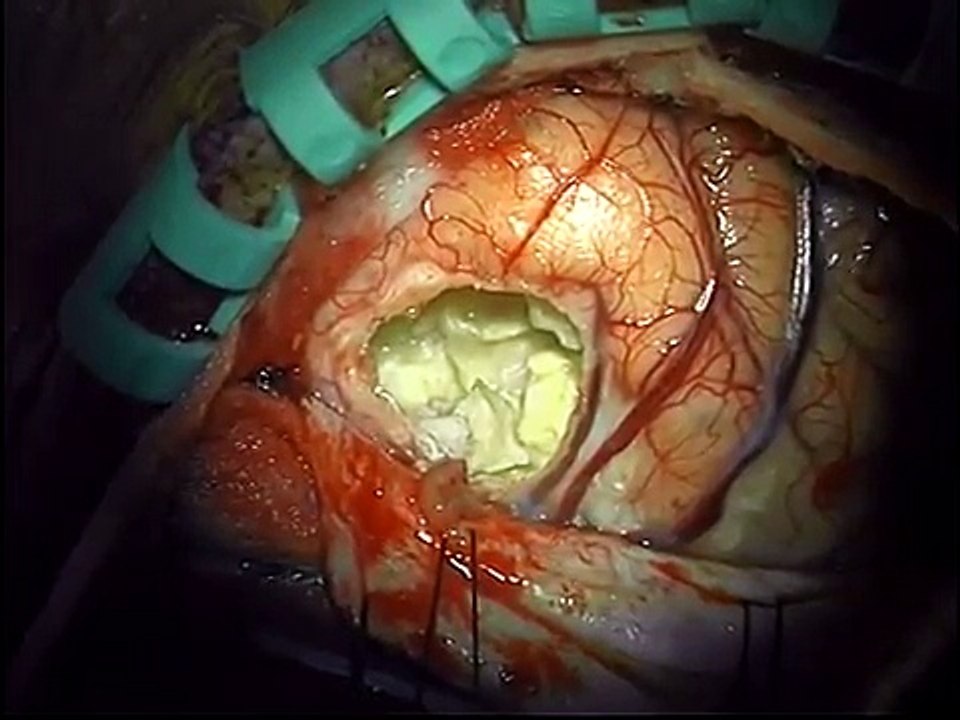 Brain tumor-Bilateral frontal epidermoid-microsurgical removal-dr suresh dugani/HUBLI/KARN