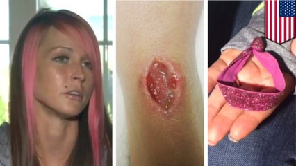 Hair-tie causes life-threatening infection, forcing woman to have surgery