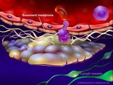 Cancer: Tissue Invasion and Metastasis