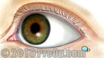 PreOp® Patient Education Opthamology: PRK Laser Eye Surgery