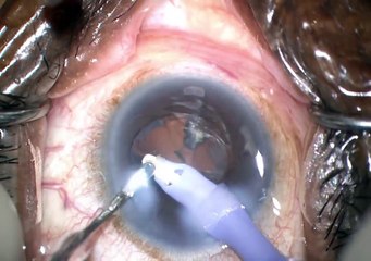 case 1 trabectome phaco superficial keratectomy part 1 narrow angles