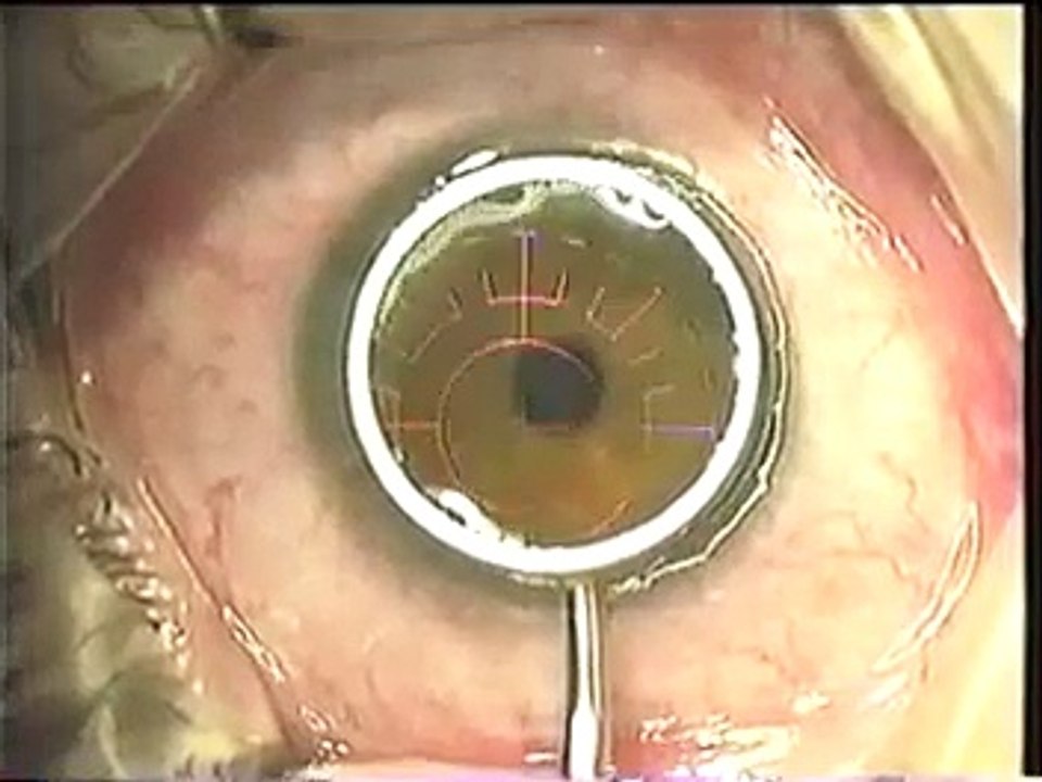 The Fladen Eye and Lasik Center: PRK Surface Ablation Laser Vision Correction