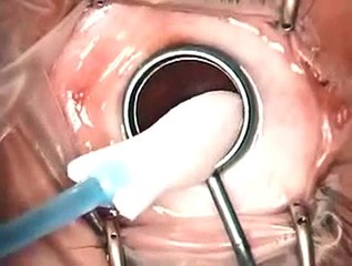 The management of cornea blindness from severe corneal scarring - Video abstract: 27175