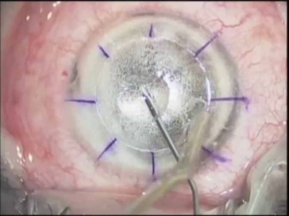 Deep Lamellar keratoplasty - Modified big bubble technique