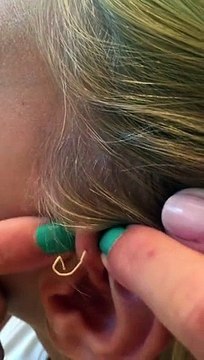 Elle éclate son bouton vieux de 6 ans, regardez ce qui sort ! Ecoeurant !