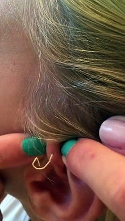 Elle éclate son bouton vieux de 6 ans, regardez ce qui sort ! Ecoeurant !