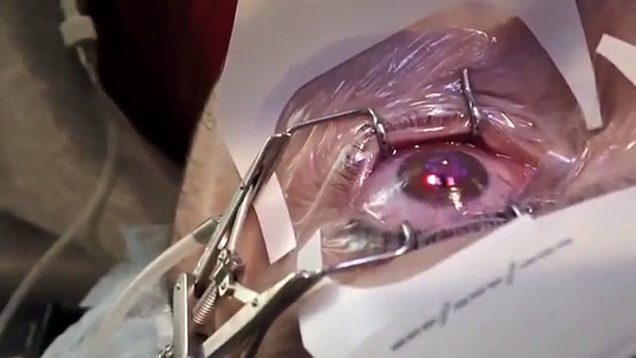 PRK laser eye surgery similar to LASIK experience