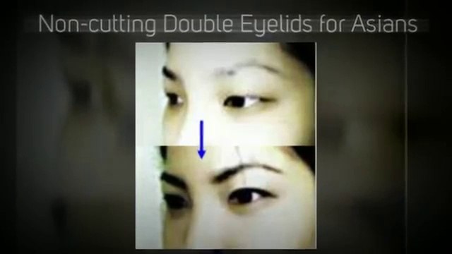 Laser treatment for tattoo removal in Tokyo Japan - PlazaClinic.net