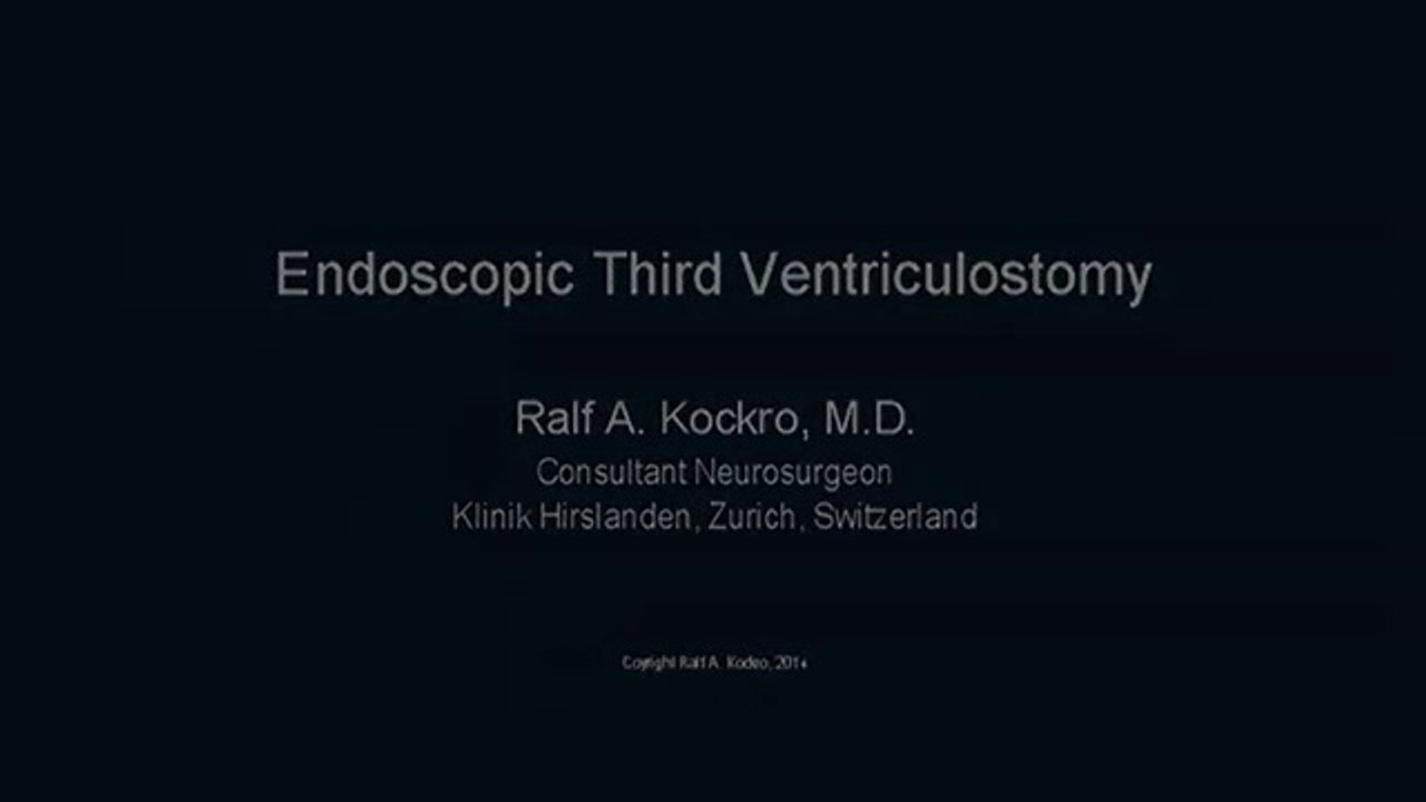 Endoscopic third ventriculostomy. Carlo Pizzoni M. D.