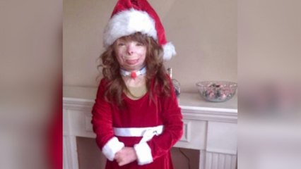 Little girl who survived fire wants you to send her a Christmas card