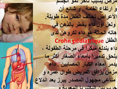 La maladie de Crohn chez l'enfant , l'adolescent et l'adulte - Traiter et prévenir