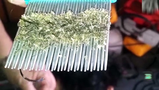 Is This The Worst Case Of Head Lice In The Entire World This Is So 