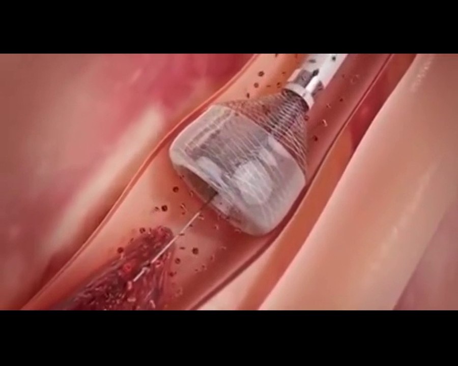 How to open human Heart Valuve